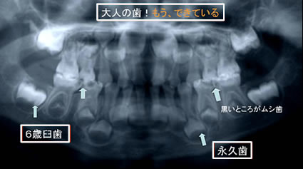 虫歯レントゲン写真